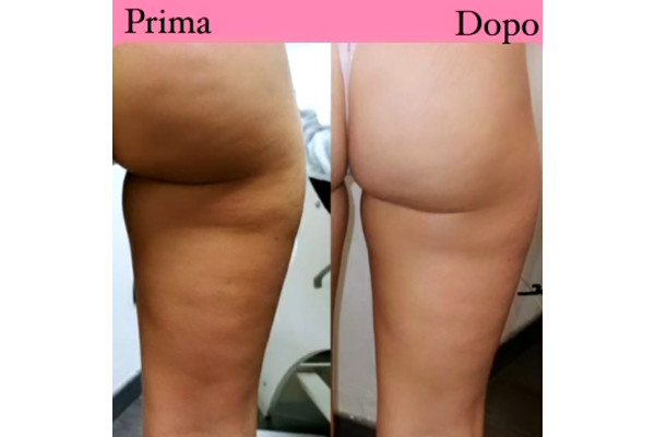 Trattamento Corpo di Estetica Avanzata
